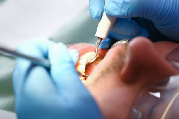 Best Emergency Wisdom Tooth Extraction in Ramsey, MN
